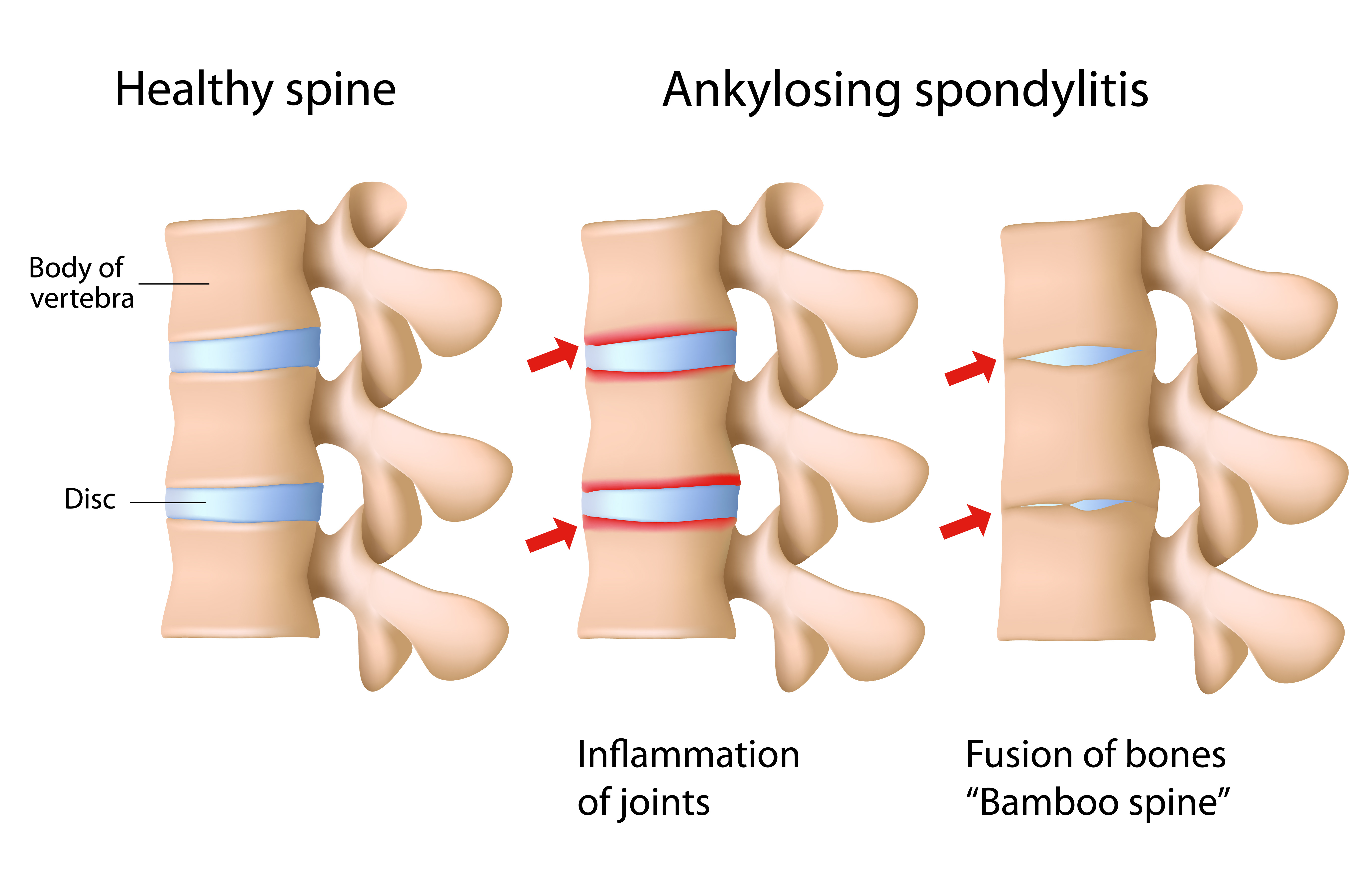 Ankylosing Spondylitis Causes Symptoms And Treatments