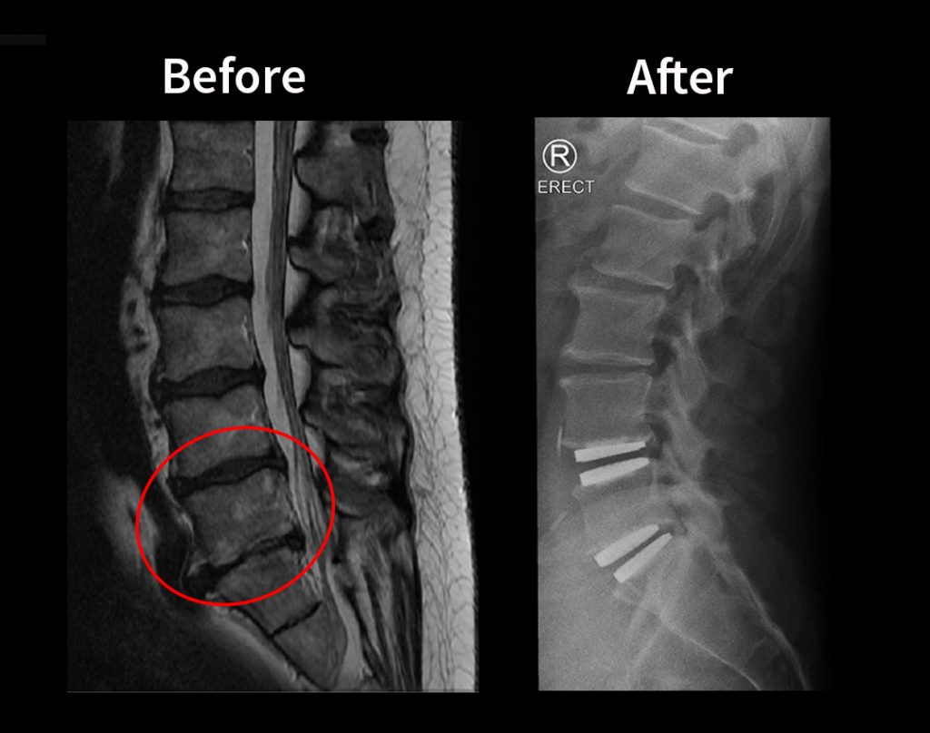 My 2Level Disc Replacement to stand straight again