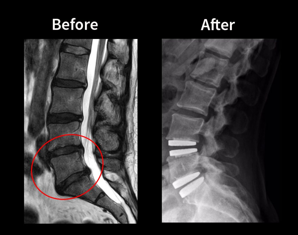 12 Days after Artificial Disc Replacement in Germany (Sue