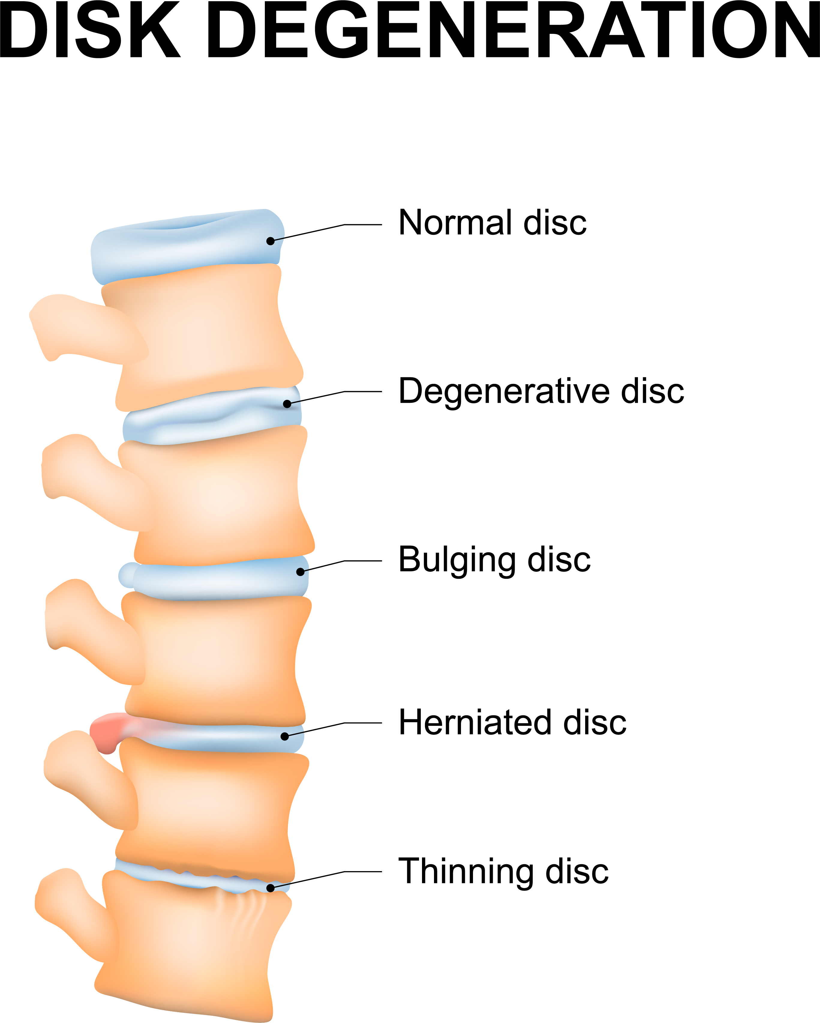 degenerative disc in thoracic spine
