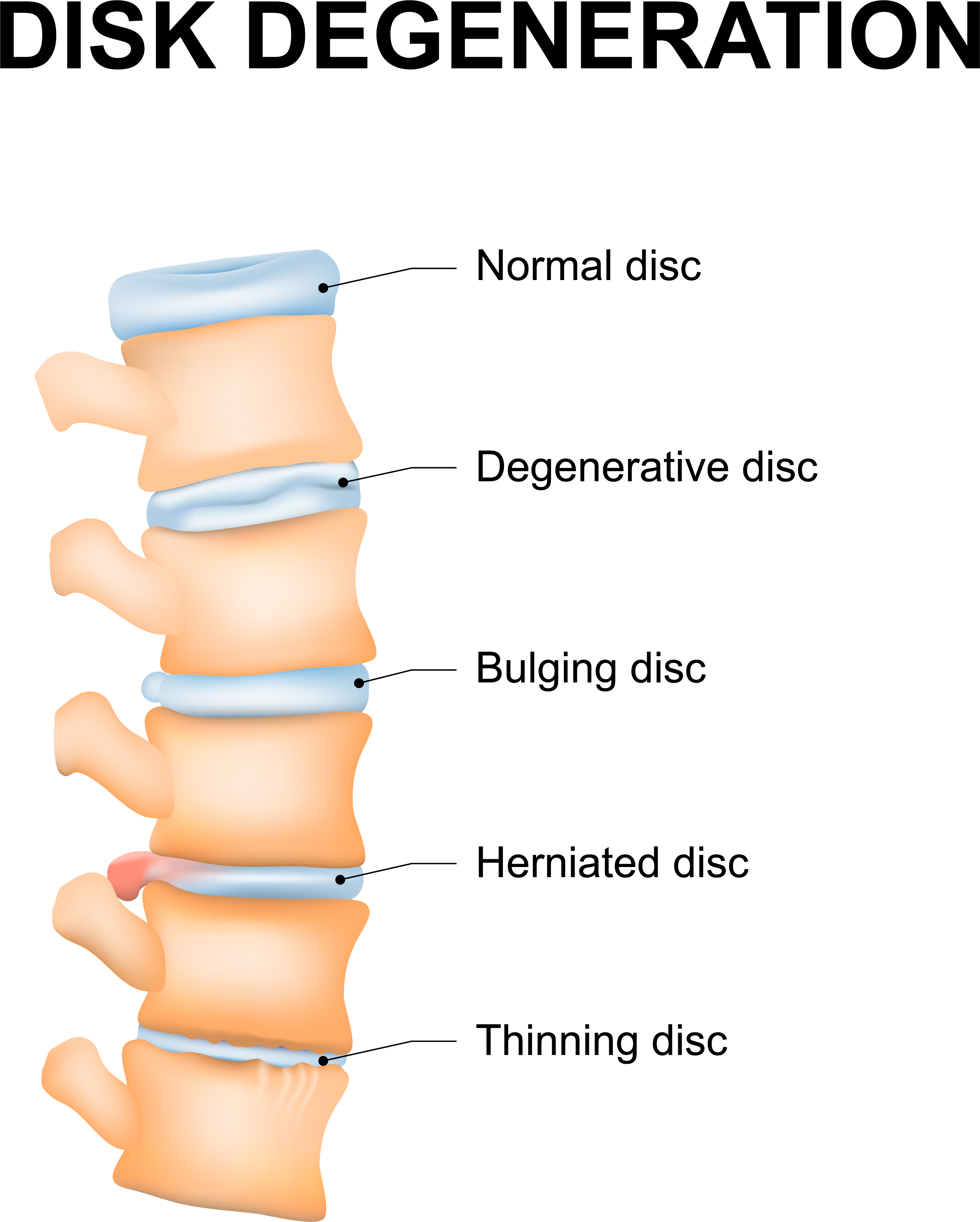 Degenerative Disc Disease DDD Causes Symptoms Treatments
