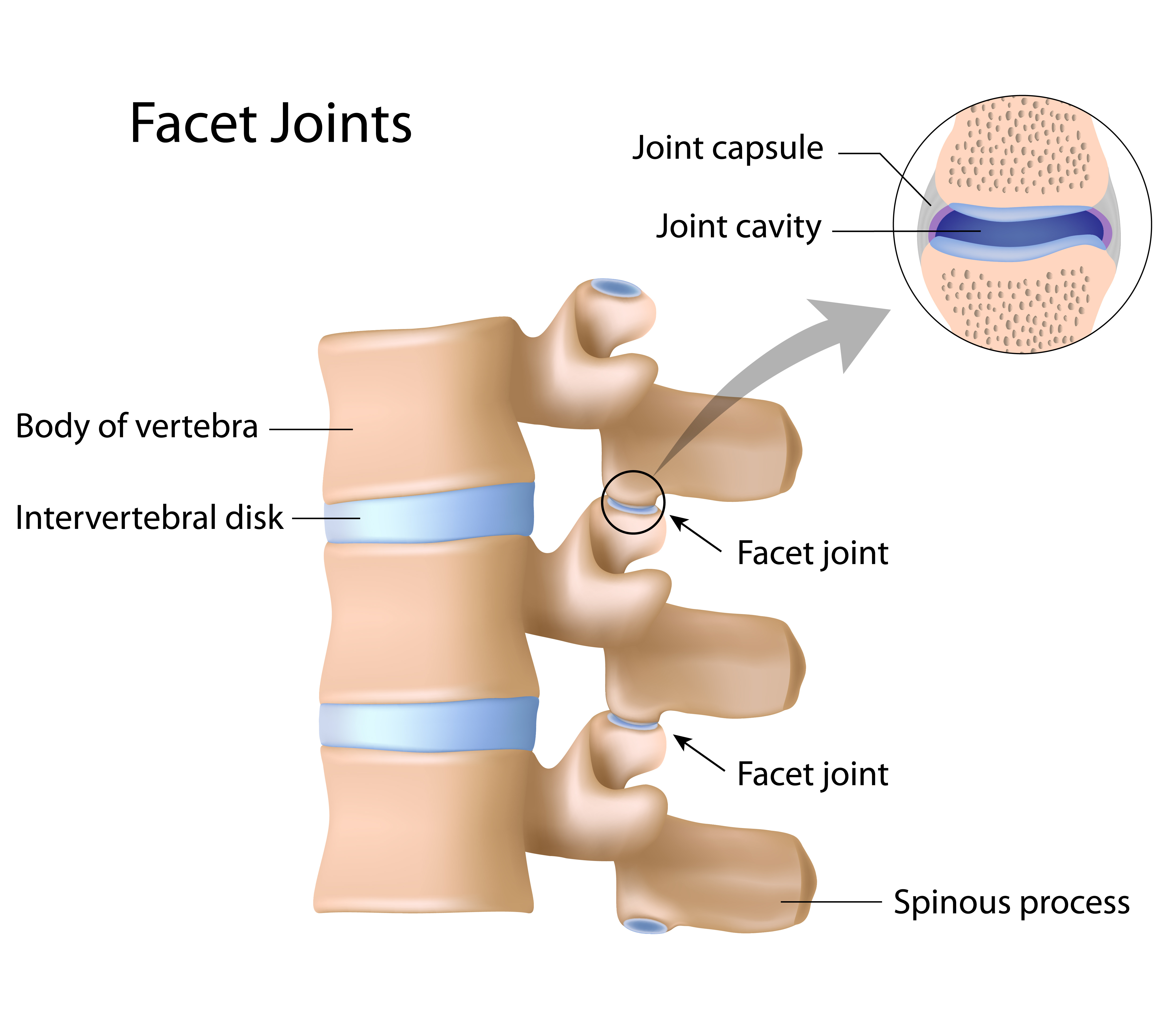 What Does Moderate To Severe Degenerative Changes Mean