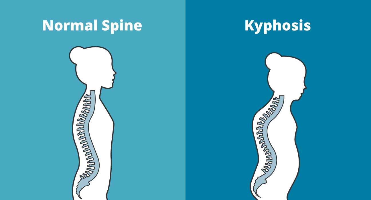Kyphosis Causes, Symptoms & Treatments