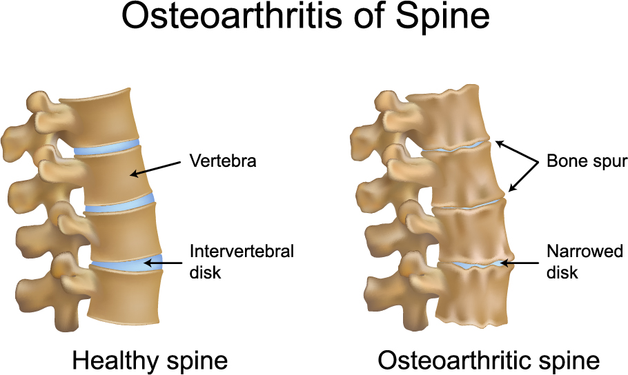 osteoarthritis-causes-symptoms-treatments