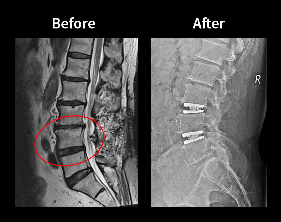 4 Spinal Discs Replaced in the Same Surgery (Savant’s Story) Spine