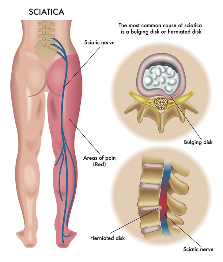 Sciatica Pain Relief Back Brace for Pinched Nerves