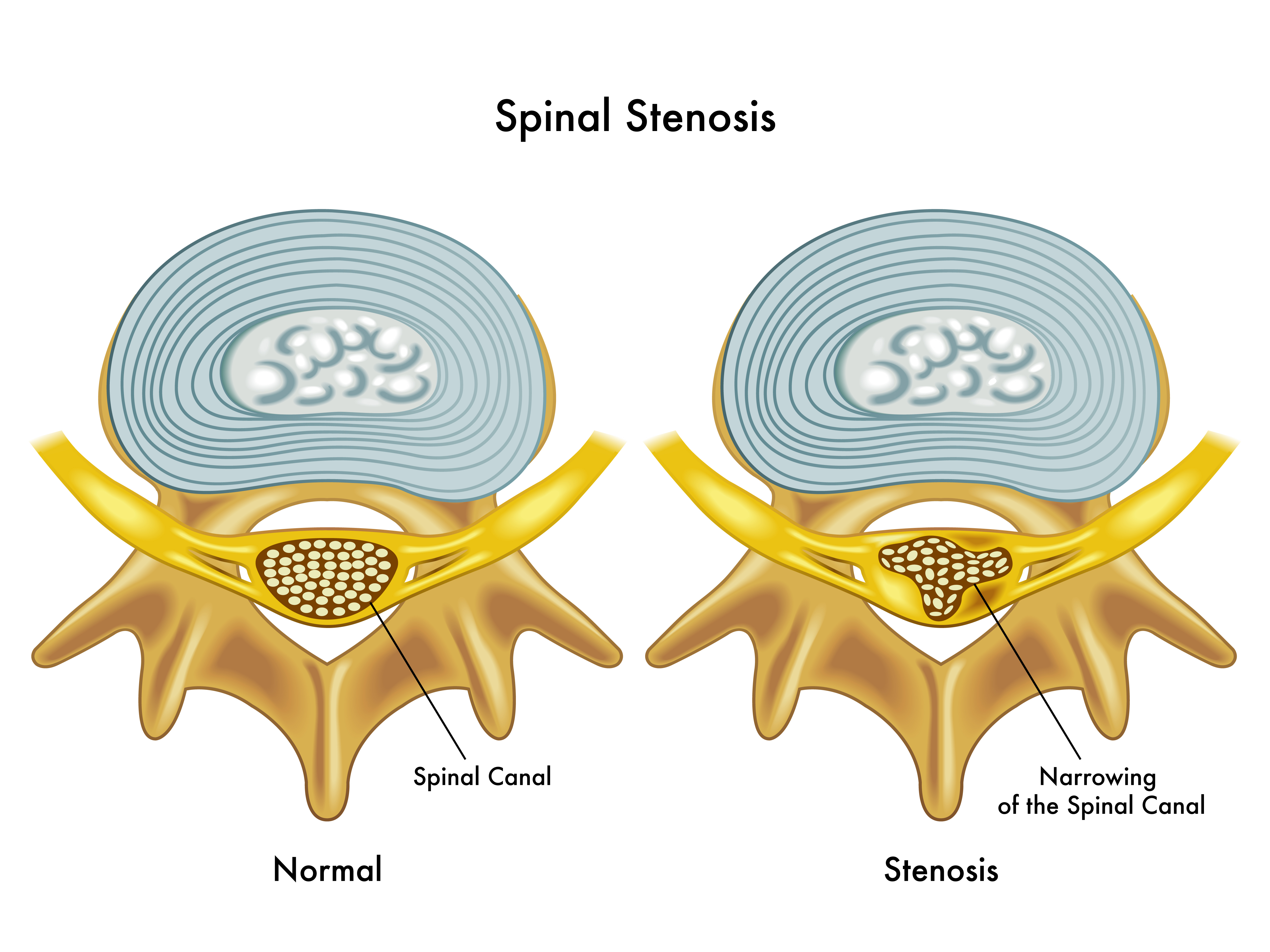 What worsens spinal stenosis?