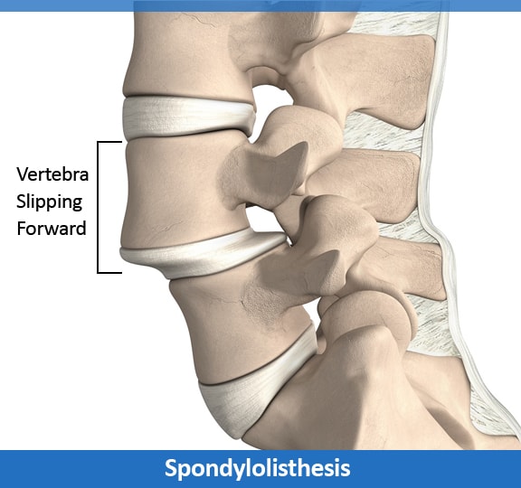 spondylolisthesis symptoms and signs