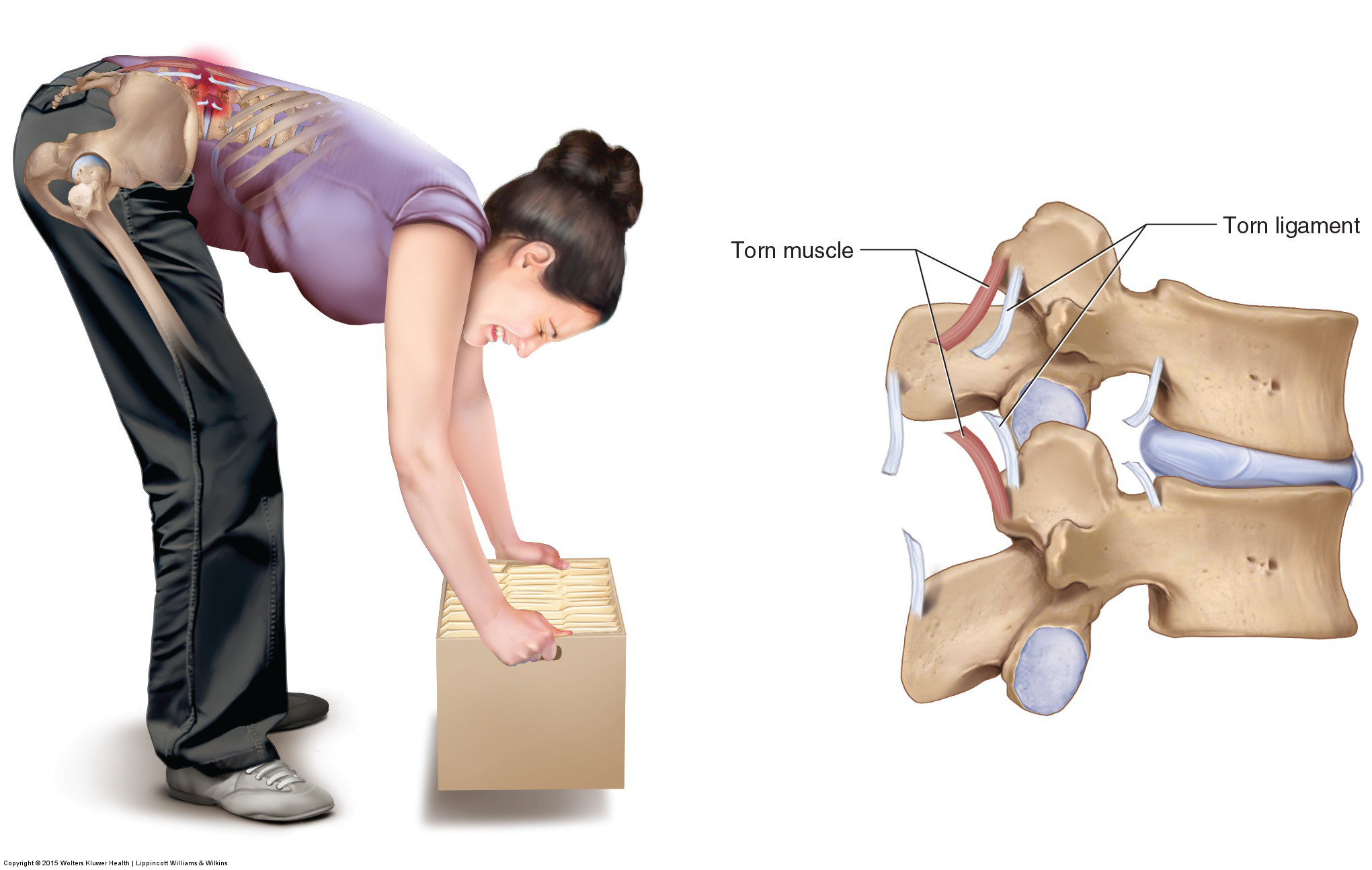 stille vores mesh Back Sprains & Strains Causes, Symptoms & Treatments