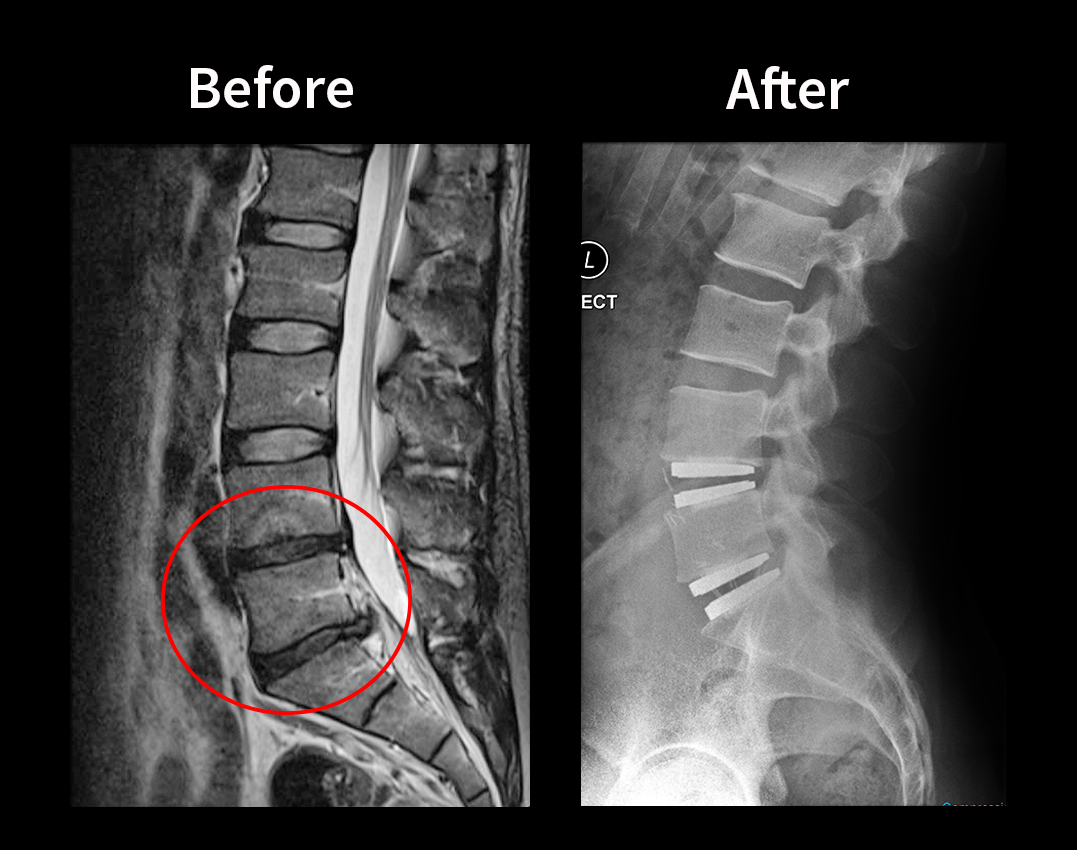 Young Fitness Instructor’s M6 Disc Replacement in Germany (Taran’s ...