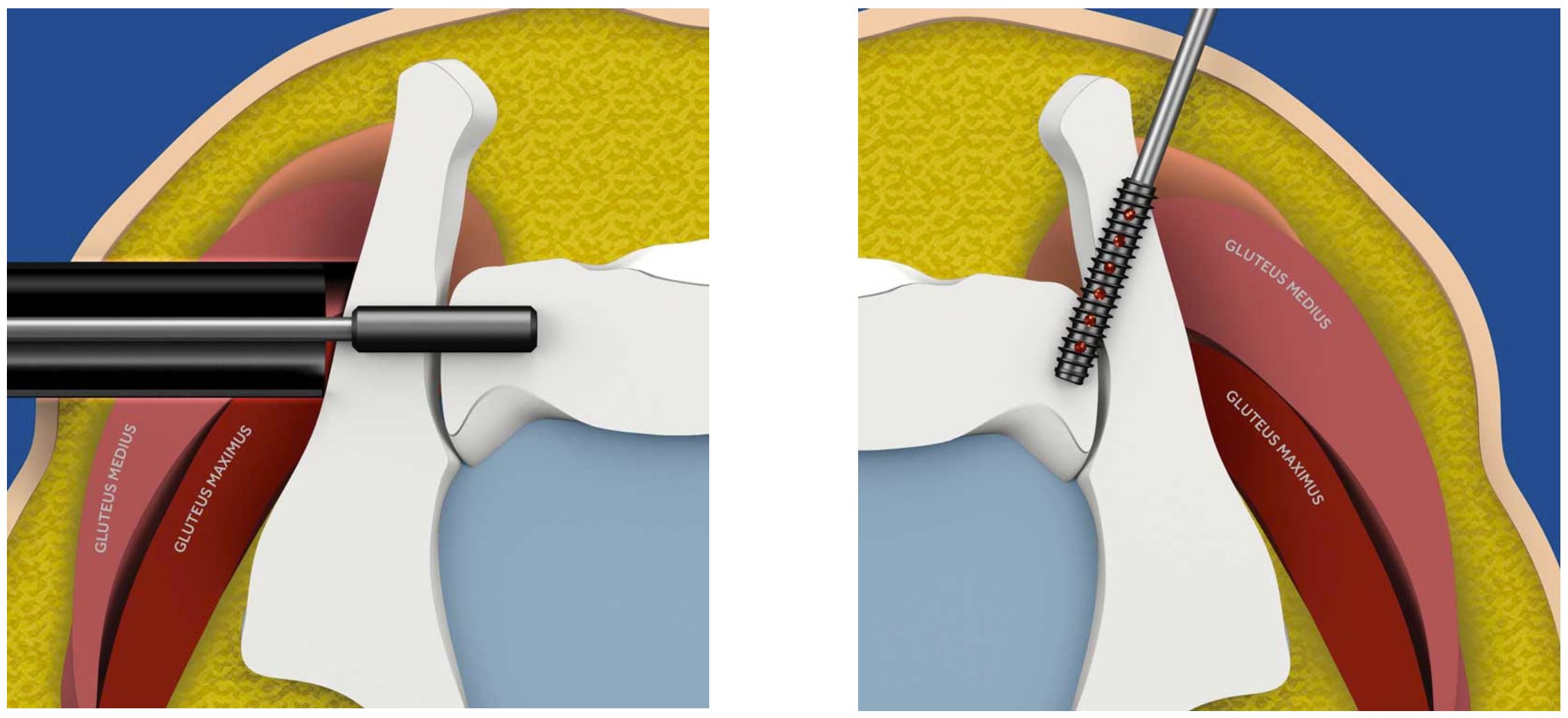 Breg | Fusion Ligament