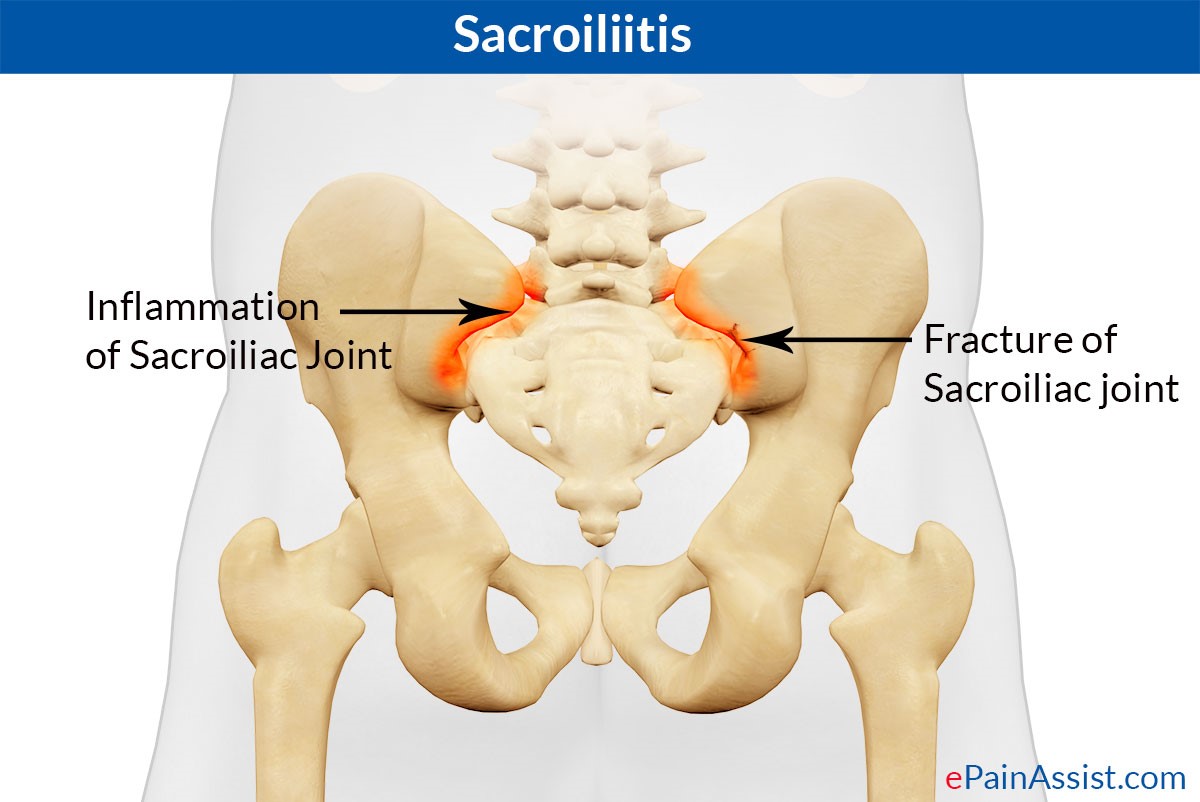 drag Omvendt Ydmyghed A Helpful Guide to Sacroiliac Joint Fusion for Pain and Dysfunction - Spine  Connection