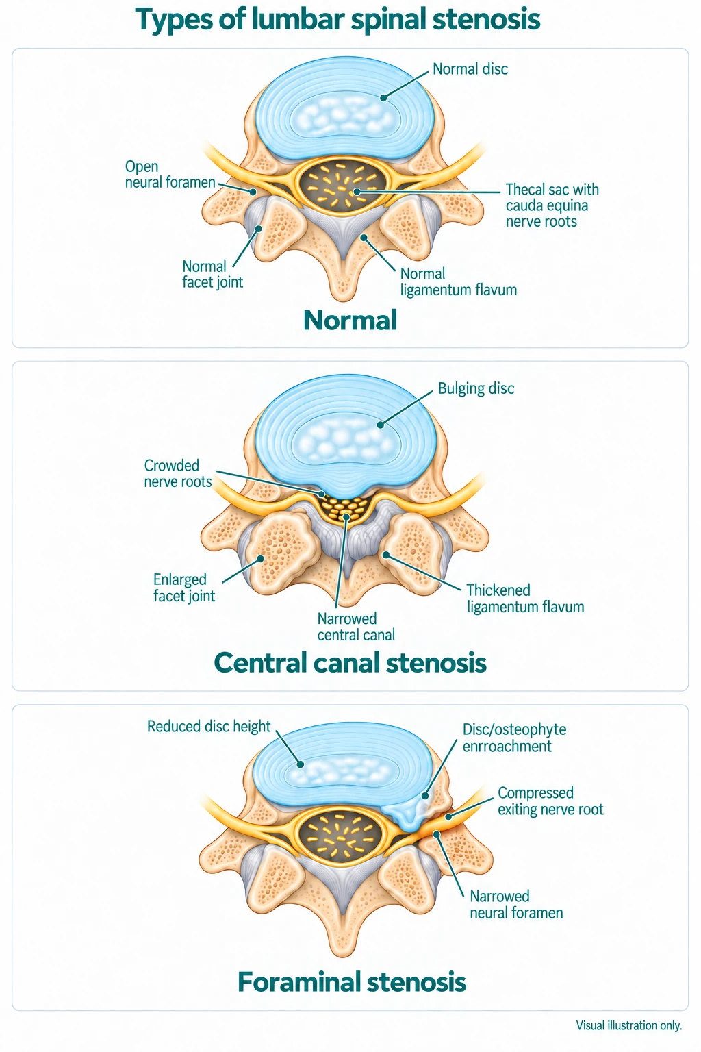 bpc 157 spinal stenosis Causes, Symptoms & Treatments coupon-oem-refrigerator-filters